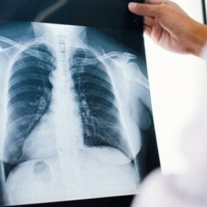 Ημερίδα ευαισθητοποίησης για τον καρκίνο του πνεύμονα στο ΚΑΠΗ Νικόπολης